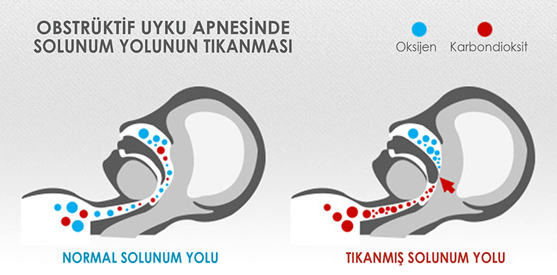 Tıkayıcı uyku apnesinin solunum yolunu nasıl tıkadığını gösteren illüstrasyon